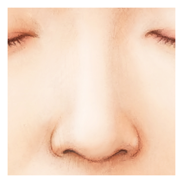 鼻孔縁形成術