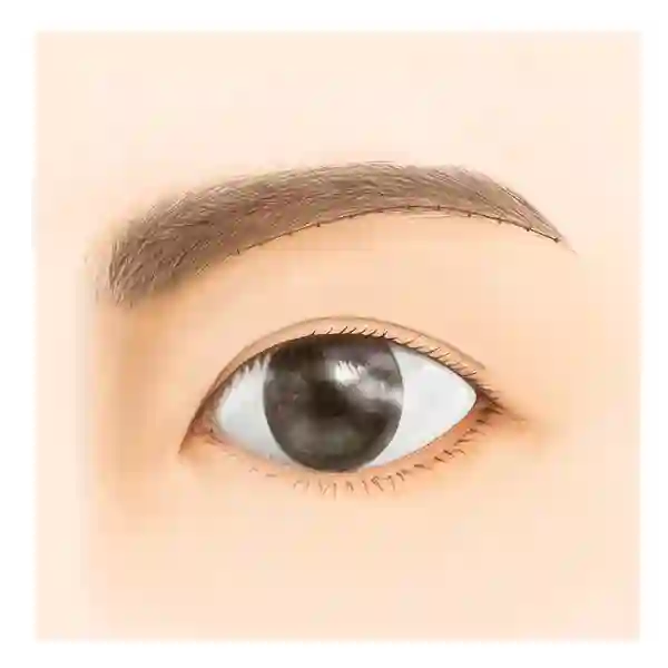 眉毛の下縁に沿って、上まぶたの皮膚を切除します。