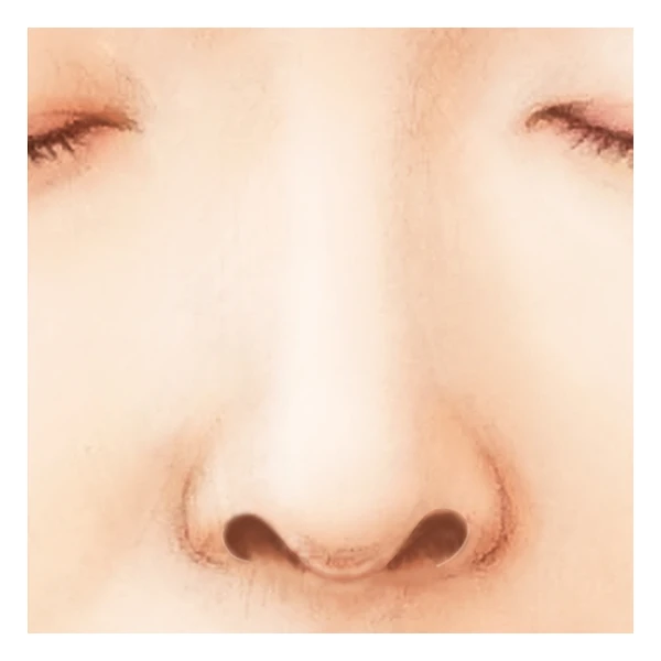 鼻孔縁形成術