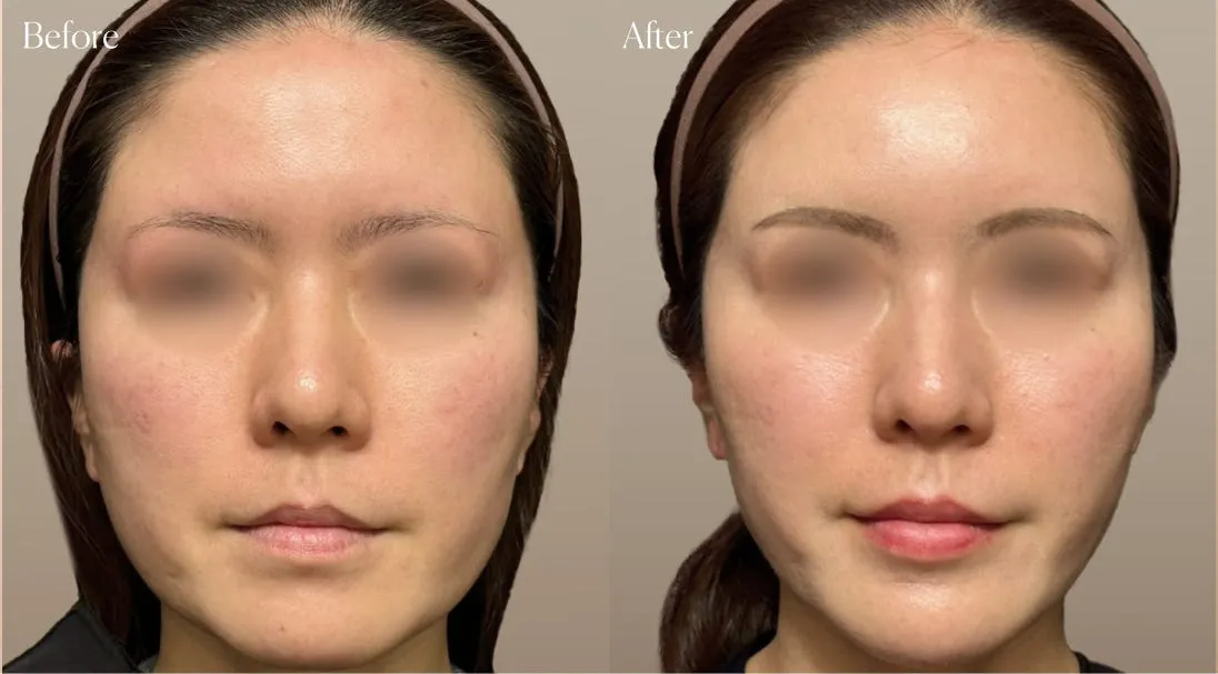 before after