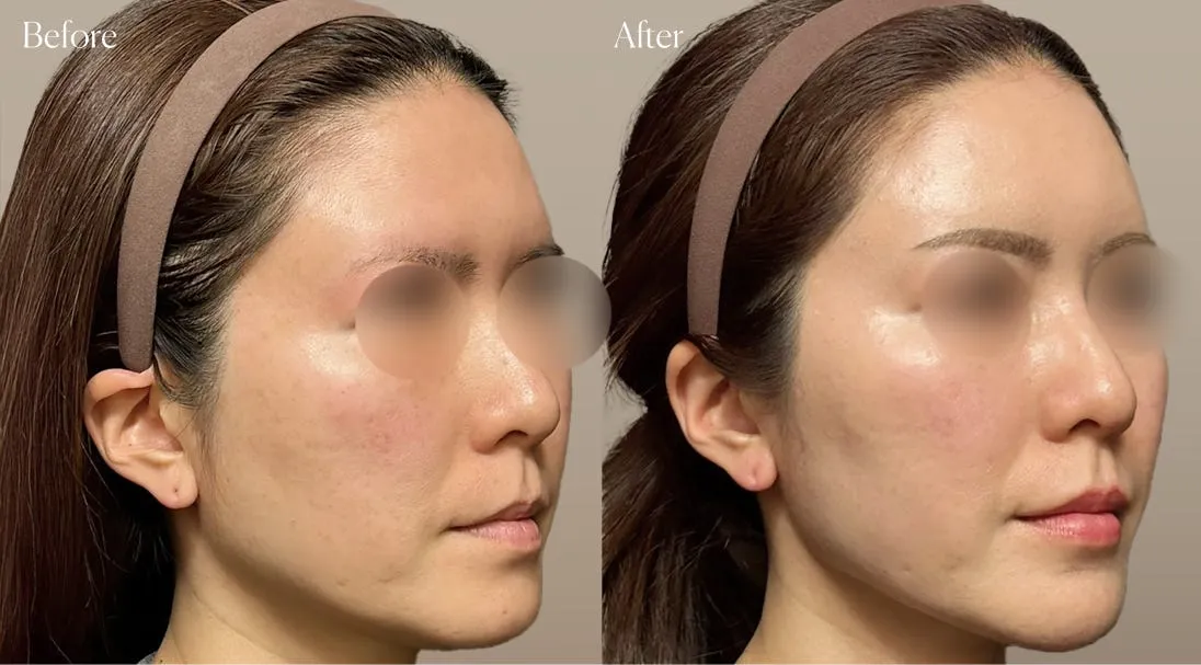 before after