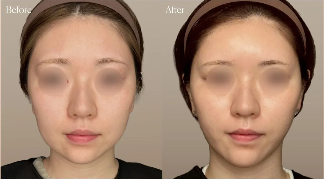 before after