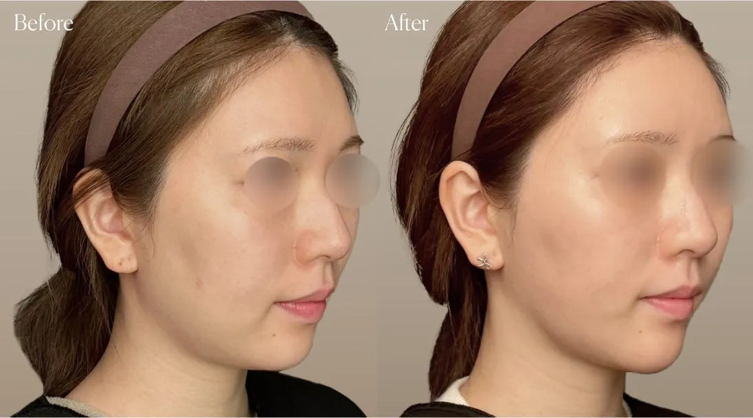 before after