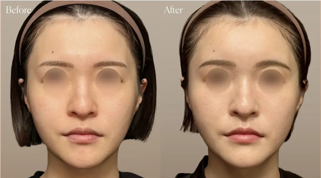 before after