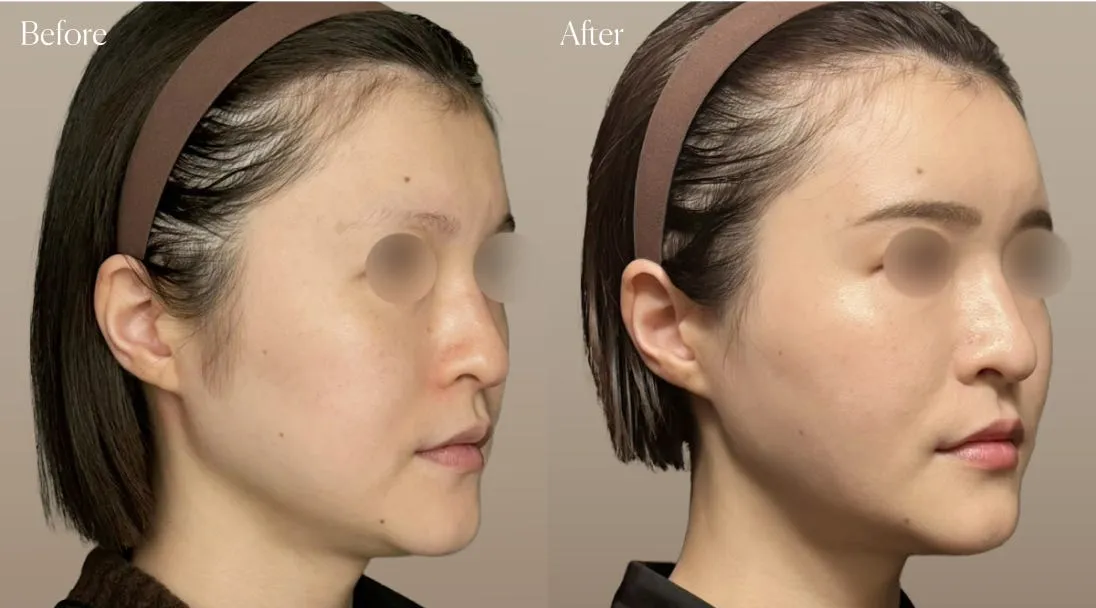 before after