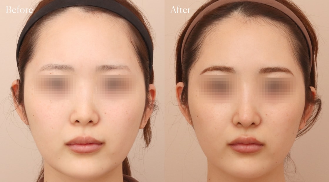 before after