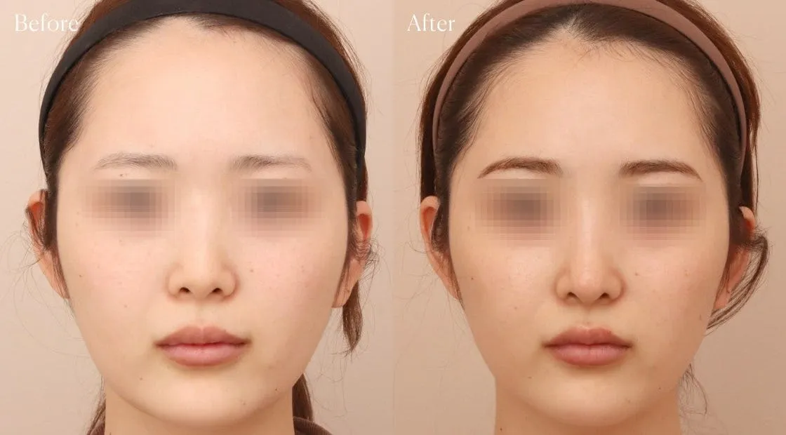 before after