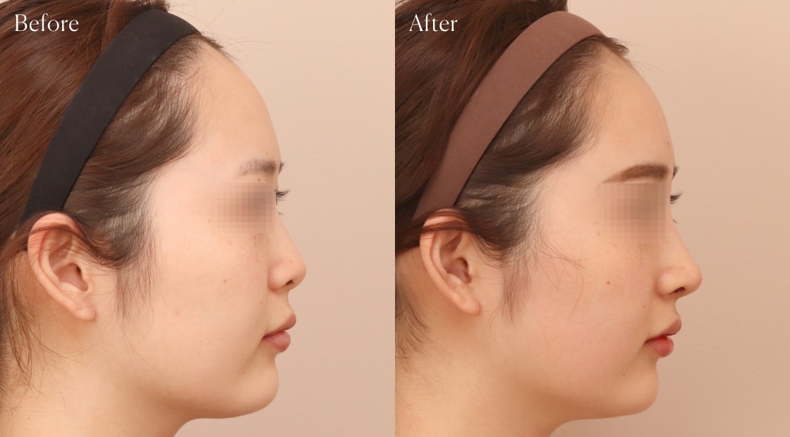 before after