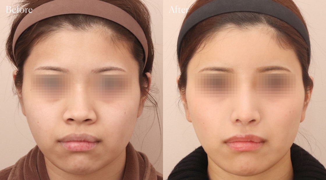 before after