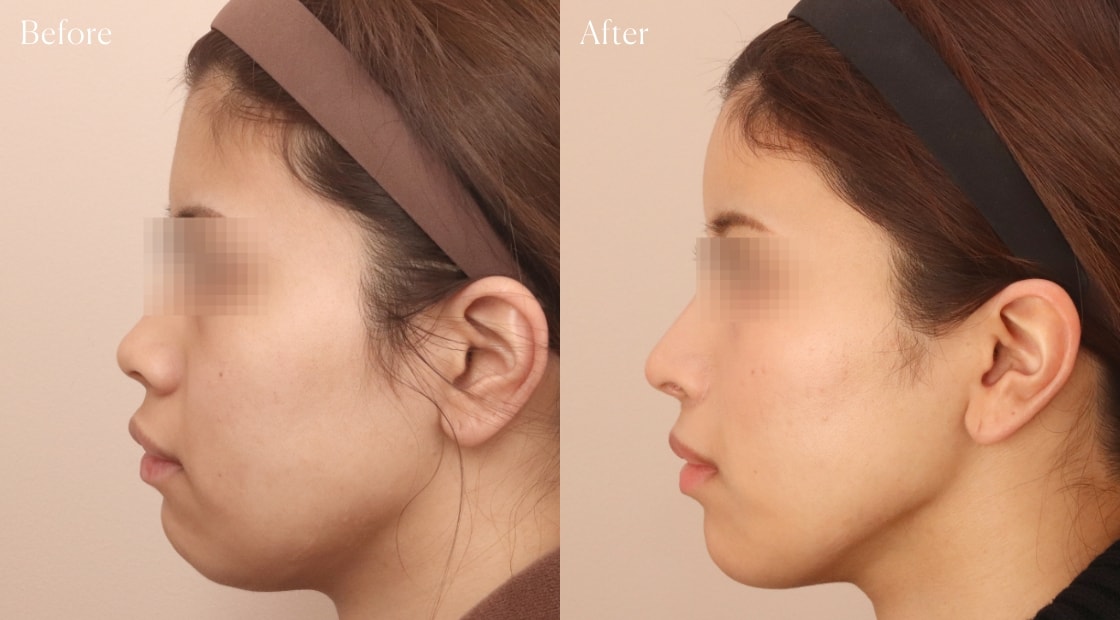 before after