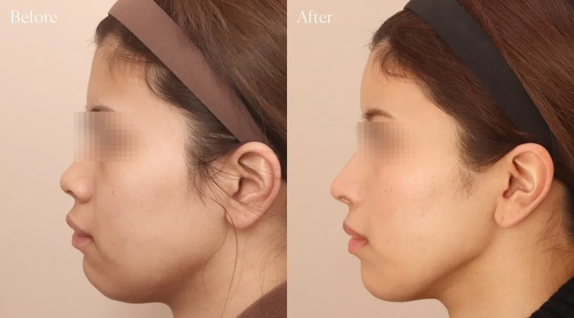 before after